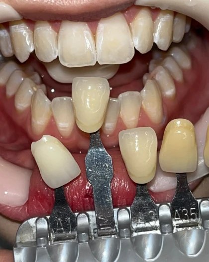 Escala de cor dos dentes em avaliação para clareamento